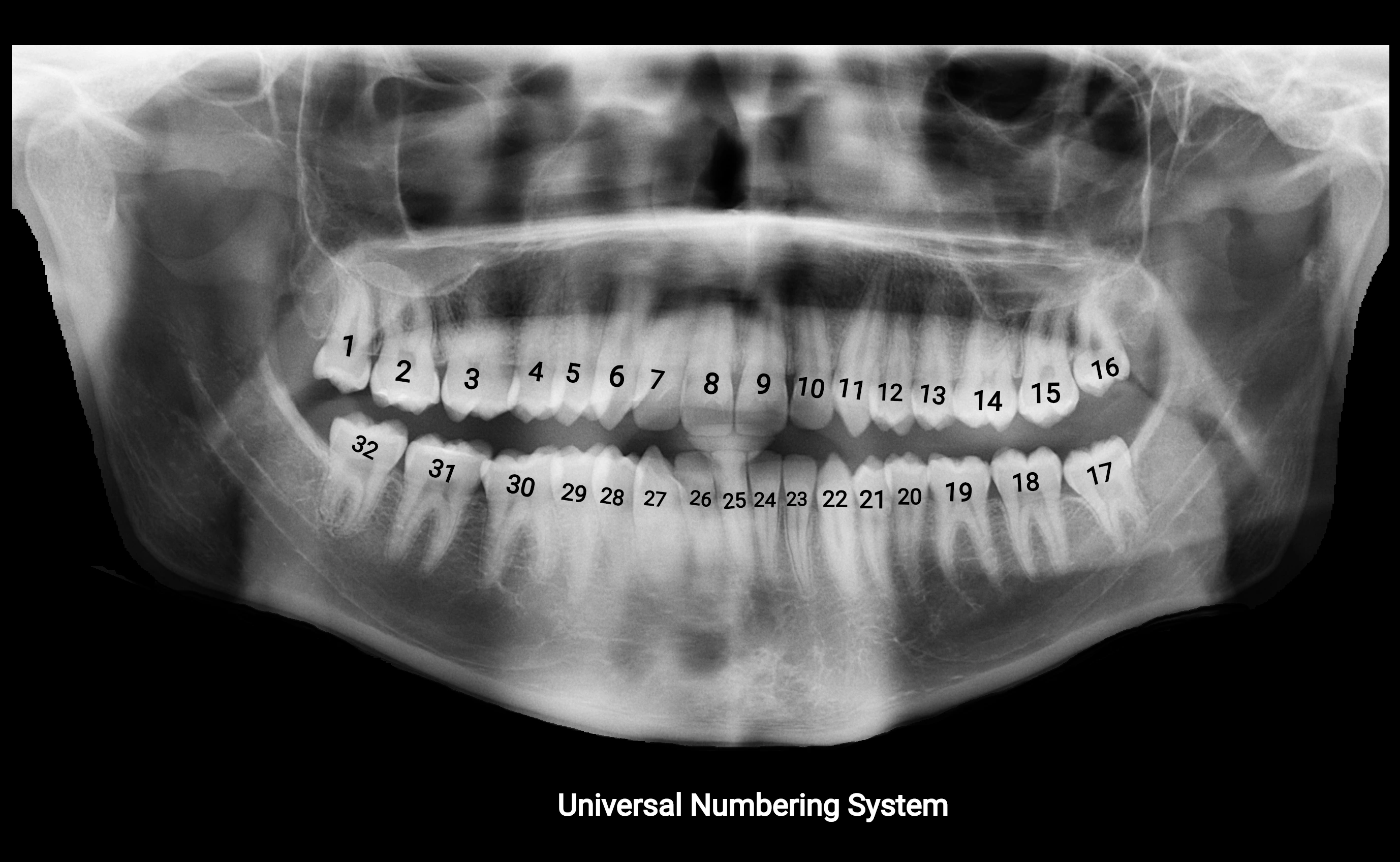 Orthopantomogram (OPG) X Ray anatomy labelled image 2.webp